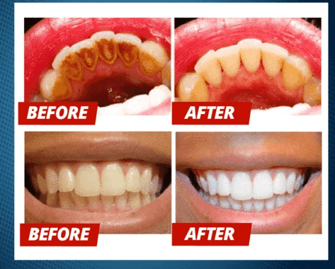 Balinanti dantų pasta–dantų priežiūra ir akinanti šypsena